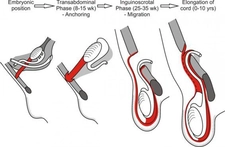 Testis İnmemesi Belirtileri ve Tedavisi
