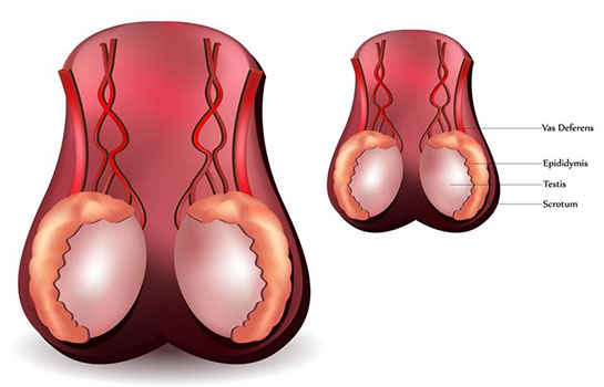 Testis Kisti